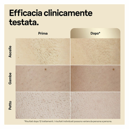 Braun Epilatore Luce Pulsata Silk·expert Pro 5, Epilazione A Casa Tua, Con Custodia, Rasoio Donna Venus, 2 Testine, PL5152