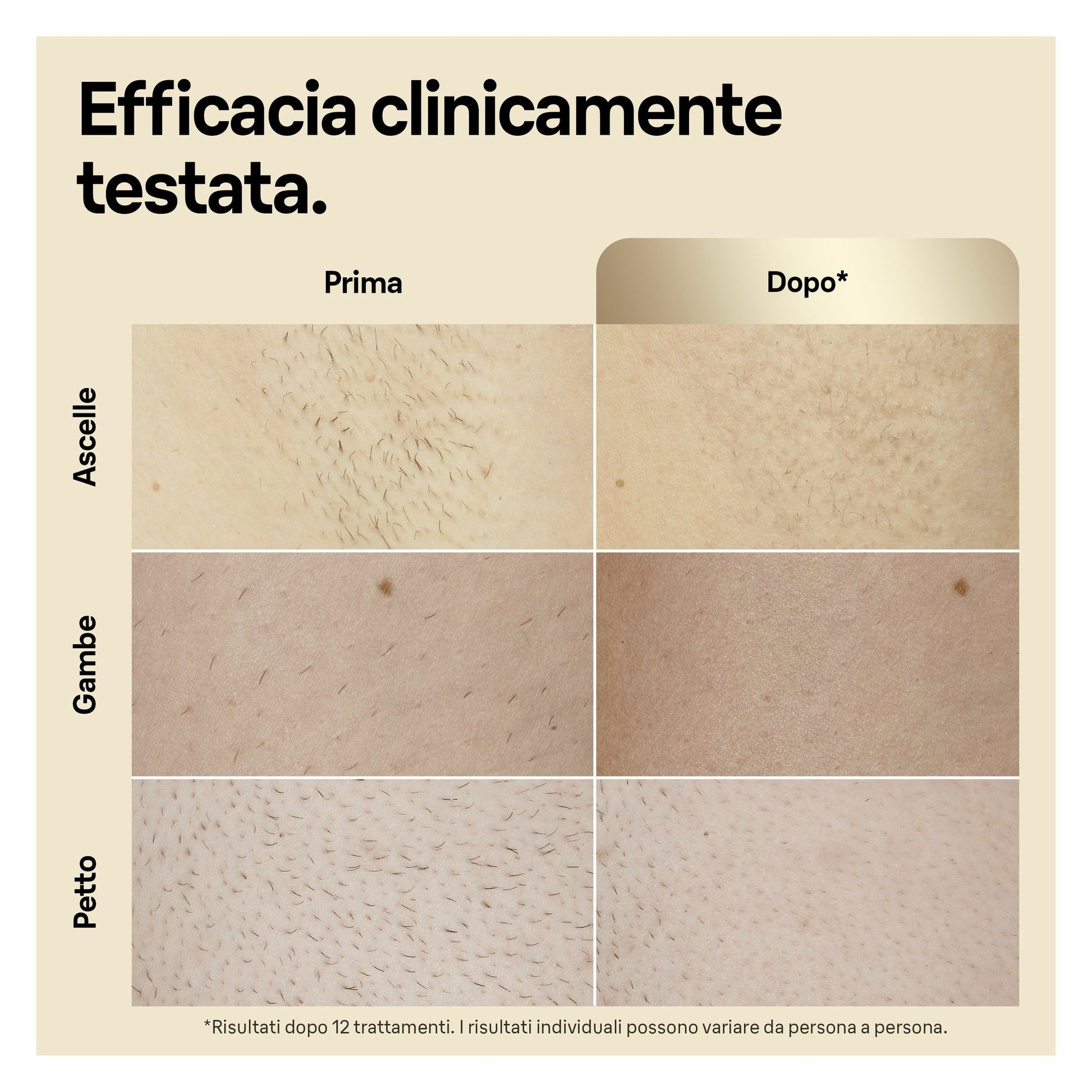 Braun Epilatore Luce Pulsata Silk·expert Pro 5, Epilazione A Casa Tua, Con Custodia, Rasoio Donna Venus, 2 Testine, PL5152